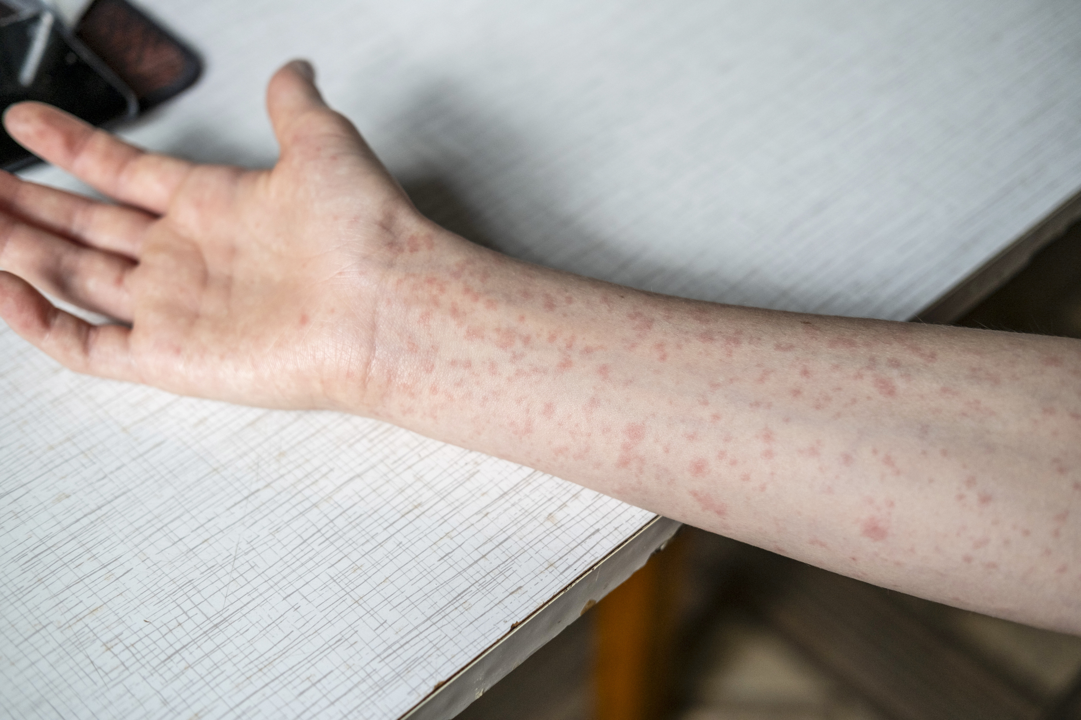 Arm with measles.